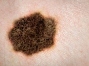 New guidelines have been released for the treatment of primary cutaneous melanoma