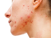 Acne relapses are significantly associated with impaired quality of life as well as productivity loss and absenteeism